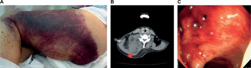 Figure 1 Hemorrhagic sites.Notes: (A) Subcutaneous, (B) intramuscular (red arrow head, trapezius muscle), (C) intestinal (sigmoid colon) hemorrhage.