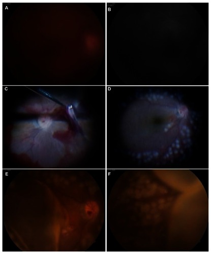 Figure 1 (A and B) Fundus photography and fluorescein angiography images revealed vitreous hemorrhage in the right eye during preoperative examinations. (C) Intraoperative findings of the first vitrectomy. (D) Fundus photographs showed no complications, including vitreous, at the end of vitrectomy. (E and F) Four hours after surgery, fundus photography showed choroidal detachment at the posterior pole and peripheral retina.