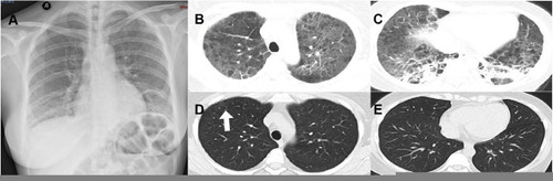 Figure 1 Chest images. (A) Chest X-ray showing bilateral patchy, cloudy opacities in the lower lungs with some adjacent pleural thickening and adhesion before treatment. (B and C) Chest HRCT showing diffused stripes as well as reticular and ground-glass opacities with honeycomb structures, primarily in the lower lungs before treatment. (D and E) Chest HRCT scan showing a faint patchy opacity in the lateral segment (white arrow).