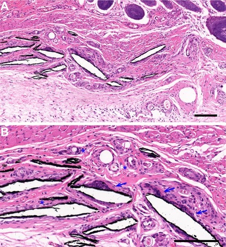 Figure 4 The host tissue response to MXene films. Histological sections of the tissue surrounding the MXene films after HE staining, 2 weeks after surgery. Macrophages (blue arrows) and many blood vessels (blue asterisks) were observed around the cracked MXene film chips. Blue arrows mark the macrophages and blue asterisks mark the blood vessels. Low magnification (A) Scale bar: 150 μm and high magnification (B) Scale bar: 50 μm.