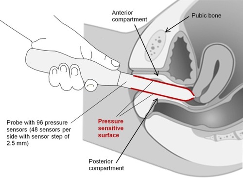 Figure 3 Vaginal tactile imaging probe during pelvic floor examination.