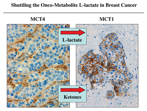Figure 4 Shuttling the onco-metabolite L-lactate from the tumor stroma to epithelial cancer cells. Previously, we proposed that a “lactate shuttle” also exists in human breast cancers. More specifically, the distribution of lactate transporters is highly compartmentalized in human breast cancers. Note that MCT4 (a marker of aerobic glycolysis and L-lactate secretion) is largely confined to cancer-associated fibroblasts in the tumor stroma. Conversely, MCT1 (a marker of L-lactate uptake) is localized to epithelial cancer cells. Because of their broad specificity, the same MCT transporters can also function in the shuttling of ketone bodies from the tumor stroma to epithelial cancer cells. Arrows indicate the direction of energy transfer. Reproduced and modified with permission from reference Citation57.