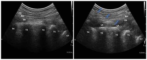 Figure 1. Ultrasound‐guided erector spinae plane block. (a) before local anesthetic injection (b) after local anesthetic injection. Tz: trapezius muscle, Rm: rhomboid major muscle, ES: erector spinae muscle, T: transverse processes of the thoracic vertebrae, C: transverse processes of the cervical vertebrae, LA: local anesthetic