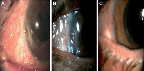 Figure 4 A sequence of three photographs showing one of the treated cases (patient #4) with an epithelial and stromal defect in the left eye with new vessels, and an additional limbic insufficiency.