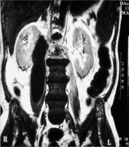 Figure 4. MRI from a patient treated surgically.