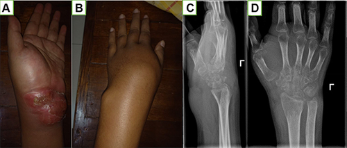 Figure 4 (A) Left wrist swelling with discharge on volar area; (B) Dorsal area of the left wrist; (C and D) X ray of the left wrist shows juxta articular osteopenia and destruction of carpal bones.