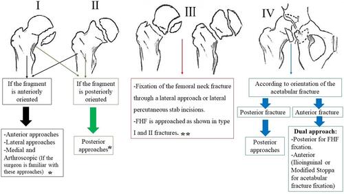 Figure 3 Example flow chart showing how to select the most appropriate approach for femoral head fractures (FHFs) surgical management as per Pipkin classification (Type I: Fracture below fovea, Type II: Fracture above fovea, Type III: Type I or II with an associated femoral neck fracture, and Type IV: Type I or II with associated acetabular fracture). * The mentioned approaches could be used for either fragment fixation or excision, ** better to avoid a posterior approach to preserve the blood supply.