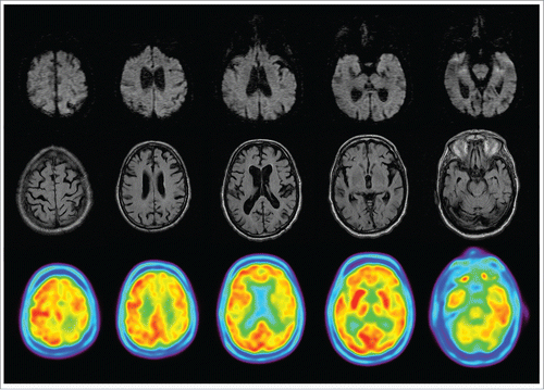 FIGURE 1. MRI and FDG-PET. In upper row, diffusion-weighted imaging with no alterations. In middle row, fluid attenuated inversion recovery (FLAIR) sequence showing global atrophy. In lower row, FDG-PET imaging showed a left frontal-parietal, bilateral thalamus and cerebellar hypometabolism.