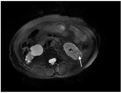 Figure 1 Magnetic resonance imaging demonstrating left renal nodule adjacent to the bowel before microwave ablation (arrow).