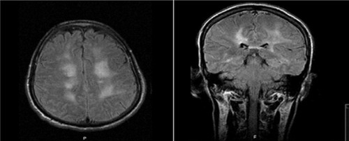 Figure 1 CT scan of brain at two different levels, both show white lucencies in the white matter and around ventricles.