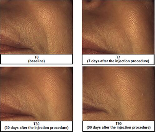 Figure 4 Representative image analysis of improvement of nasolabial folds before treatment (T0), 7 days (T7), 30 days (T30) and 90 days after injection of the brand-new intracutaneous filler. The subject’s midface was evaluated by mean of Vectra H1.