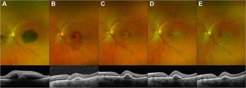 Figure 6 Colour fundus retinal photography and OCT scan before surgery (A), at month 1 (B), at month 3 (C), at month 6 (D) and at 1 year of follow-up (E).