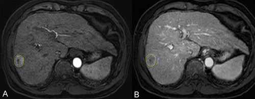 Figure 2 ROI segmentation. The largest dimension of the lesion in the arterial (A) and portal venous phases (B) was selected and ROIs were sketched along the edge of the lesion.