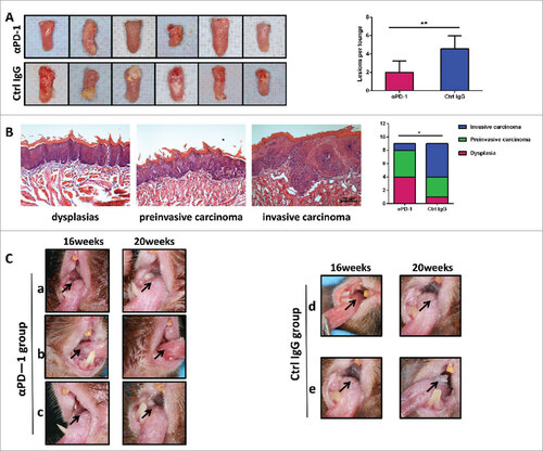 Figure 4. Anti-PD-1 mAb treatment inhibits tongue musoca lesions growth and delays carcinogenesis. (A) Photos of representative tongues of control IgG-treated and anti-PD-1 mAbs-treated mice. Anti-PD-1 mAbs-treated mice had decreased tongue musoca lesions. Data represent average ± SD. Statistical significance was determined by Student t test, ##p = 0.0015. (B) Representative Hematoxylineosin (HE) of dysplasias, preinvasive carcinoma (carcinoma in situ) and invasive carcinoma. Statistical significance was determined by Mann-Whitney U test, #p < 0.05. (C) The contrast of macroscopic observation of lingual mucosal lesion with anti-PD-1 antibodies or Hamster IgG antibodies. a and b, Reduction of lingual mucosal lesion with anti-PD-1 antibodies. c, No change of lingual mucosal lesion with anti-PD-1antibodies. Lesions appearing as leukoplakic lesion with smooth surface changed to rough, granular surface (d) or exogenous verrucous surface (e).