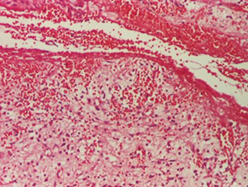 Figure 4 Hyperplasia of the epidermis and the presence of a fistulous tract lined with granulation tissue and hemorrhage (HE stain, x40).