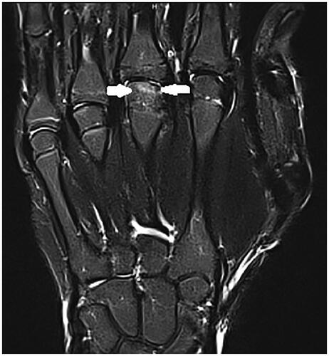 Figure 4. Second MRI, October 2022, vascularization seems preserved in T2 weighted images.