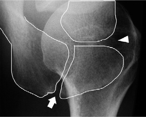 Figure 2. Axillary radiograph of a right shoulder with an os meso-acromiale. The white arrow indicates the non-ossified gap between the os meso-acromiale and the acromion; the white arrowhead indicates the AC joint. The non-ossified gap between the os meso-acromiale and the acromion ends within the AC joint and the articular facet is not 5–10 mm posterior to the anterior margin.