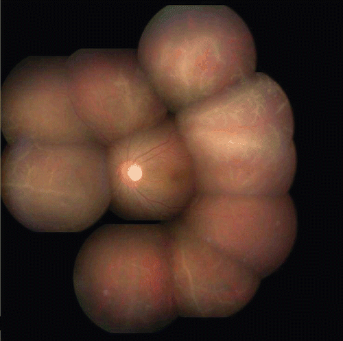 FIGURE 2  Fundus photograph of left eye pre-therapy showing retinal vessels with perivascular sheathing with retinal hemorrhages before treatment.