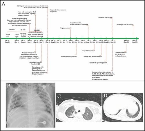 Figure 1. Timeline and chest imaging. Panel A is a timeline of the clinical course of the patient (PICU), paediatric intensive care unit; CSF, cerebrospinal fluid. Chest radiography (Day 6 of illness) indicated bilateral patchy shadows with consolidation in the right lung upper lobe (Panel B). Chest computed tomography showed consolidation of the right lung upper lobe (Panel C) and mild consolidation of the bilateral lower lobe near the pleura (Panel D).