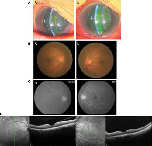 Figure 1 Initial ocular manifestations.