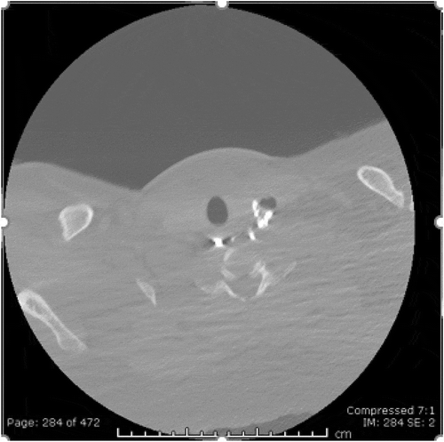 Figure 4. CT soft tissue neck with intravenous contrast. Extraluminal contrast within a cavity likely representing diverticulum. No perforation