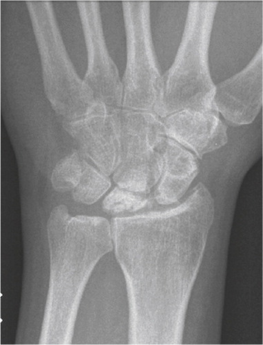 Figure 3. Frontal radiograph demonstrating lunate malacia. The lunate is fractured and fragmented, and the carpal height reduced.