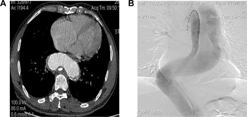 Figure 1 A 63-year-old man who presented with 3 months of chest and back pain was diagnosed with chronic TBAD with aneurysm degeneration (using patient 4 as an example). Total stent graft diameter and length were 36 mm and 200 mm, respectively. Two RBSs were implanted, and the diameter of the proximal RBS was 26 mm.