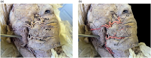 Figure 3. (a) FA2 Runs transversely across the cheek to give branches to the superior labial artery (SLA) and lateral nasal artery (LNA). FA1 gives rise to MeA, which gives rise to the inferior labial artery (ILA). (b) Figure 3(a) with arteries outlined in red.