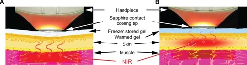 Figure 2 Schematic of our NIR treatment for skin tightening. (A) NIR treatment targeting superficial muscles with the freezer-stored gel (approximately −10°C to 10°C). (B) NIR, treatment targeting dermis with the gel (approximately 10°C–30°C).