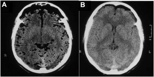 Figure 1 (A) Axial CT view depicting an extensive posttraumatic PNC with air bubbles located in the subaracnoid and subdural compartments. (B) Axial CT view after three sessions of HBO2 therapy.