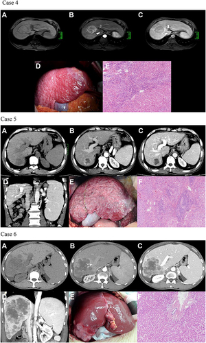 Figure 1 Images to illustrate construction of LFSS. Case 1: A 24-year-old woman with a large right lobe HCC. Preoperative axial multiphasic CT images (A–C) showing typical radiological features of HCC, normal liver morphology, and regular margin. (A) unenhanced CT phase; (B) arterial phase; (C) portal venous phase. Intraoperative photography (D) showed normal liver morphology, absence of regenerative nodules, and ruddy liver parenchyma. According to our LFSS criteria, preoperative radiological evaluation score: 0 (normal morphology), intraoperative observation: 0 (no liver regenerated nodules), liver gross appearance color: ruddy (0), thus total score of LFSS was 0 (None). (E) Histological evaluation of paracancerous parenchyma showed G1 and S1 (HE, 100×). Case 2: A 37-year-old woman with spontaneous rupture of HCC in segment IV. Preoperative axial multiphasic CT images (A–C) showing hypertrophy of the lateral segments of the left liver lobe and regular hepatic margins. (A) unenhanced phase; (B) arterial phase; (C) portal venous phase. Notes: Filling defect caused by tumoral thrombosis was noted in the sagittal part of left portal vein. Intraoperative photography (D) showed multiple micro-regenerative nodules and red liver parenchyma. According to our LFSS criteria, preoperative radiological evaluation score: 1 (morphological change), intraoperative observation: 1 (multiple regenerative micronodules), liver gross appearance color: red (0), thus total score of LFSS was 2 (Mild). (E) Histologic evaluation of paracancerous parenchyma showed G3 and S2 (HE, 100×). Case 3: A 47-year-old man with HCC in the segment VIII. Preoperative axial multiphasic CT images (a-c) were obtained showing liver morphologic change (atrophy of the posterior segments of the right liver lobe) and regular margin. (A) unenhanced phase; (B) arterial phase; (C) portal venous phase. Notes: Anterior branch of right portal vein and distal branch of middle hepatic vein invaded by tumor. Intraoperative photography (D) showed multiple regenerative micronodules and greyish-red liver parenchyma. According to our LFSS criteria, preoperative radiological evaluation score: 1 (morphological change), intraoperative observation: 1 (multiple regenerative micronodules), liver gross appearance color: greyish-red (1), thus total score of LFSS was 3 (Moderate). (E) Histologic evaluation of paracancerous parenchyma showed G3 and S3 (HE, 100×). Case 4: A 57-year-old man with HCC in segment VIII. Preoperative axial multiphasic MR images (A–C) showing liver morphologic changes (atrophy of the posterior segments of the right lobe and medial segments of the left lobe, hypertrophy of the lateral segments of the left lobe) and irregular hepatic margins. (A) precontrast phase; (B) hepatic arterial phase. Notes: Enhancement of portal vein branches but not of hepatic vein branches in hepatic arterial phase; (C) portal venous phase. Notes: Middle and right hepatic veins were compressed by tumor. Intraoperative photography (D) showed multiple regenerative nodules and red liver parenchyma. According to our LFSS criteria, preoperative radiological evaluation score: 1 (morphologic change), intraoperative observation: 2 (multiple regenerative macronodules), liver gross appearance color: red (0), thus total score of LFSS was 3 (Moderate). (E) Histologic evaluation of paracancerous parenchyma showed G3 and S4 (HE, 100×). Case 5: A 61-year-old man with HCC in segment VII. Preoperative axial multiphasic CT images (A–C) showing pronounced liver morphologic changes and irregular margins. (A) unenhanced phase; (B) arterial phase; (C) portal venous phase image; (D) coronal view shows signs of clinically significant PH (engorged and tortuous paraesophageal varices and splenomegaly). Intraoperative photography (E) showed uneven distribution of multiple regenerative micro- and macronodules and greyish-red liver parenchyma. According to our LFSS criteria, preoperative radiological evaluation score: 2 (confirmed liver cirrhosis and/or imaging features of PH), intraoperative observation: 2 (multiple macro-regenerative nodules), liver gross appearance color: 1 (greyish-red), thus total LFSS score was 5 (Severe). (F) Histologic evaluation of paracancerous parenchyma showed G4 and S4 (HE, 100×). Case 6: A 48-year-old man with HCC of the right lobe. Preoperative axial multiphasic CT images (A–C) showing pronounced liver morphologic changes, ascites and splenomegaly. (A) unenhanced phase; (B) arterial phase; (C) portal venous phase. Notes: Neither the right hepatic nor the right portal veins were visualized; (D) coronal image shows compression of the retrohepatic inferior vena cava by tumor and splenomegaly. Notes: This patient received a preoperative diagnosis of intrahepatic cholangiocarcinoma with concomitant PH and cirrhosis. However, postoperative pathology confirmed a diagnosis of HCC. Intraoperative photography (E) showed morphologic changes, no regenerative nodules, and ruddy liver parenchyma. According to our LFSS criteria, preoperative radiological evaluation score: 2 (confirmed cirrhosis and/or imaging features of PH), intraoperative observation: 0 (no regenerative nodules), liver gross appearance color: red (0), thus total LFSS score was 2, (Moderate, in contrast to preoperative assessment as Severe with indicator of PH). (F) Histologic evaluation of paracancerous parenchyma showed G1 and S0 (HE, 100×).