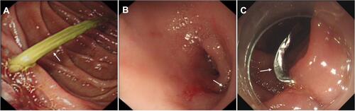Figure 3 FBs examples which were both sides embedded into the duodenal wall. (A) Impaction of a toothpick in the descending duodenum. (B) Impaction of a needle in the bulb. (C) Impaction of a denture in the descending duodenum. The white arrow points to FBs.