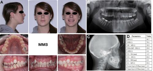 Figure 3 Pre-treatment records of patient MM3: (A) extraoral and intraoral photos; (B) panoramic radiograph; (C) cephalometric radiograph; (D) cephalometric measurements.