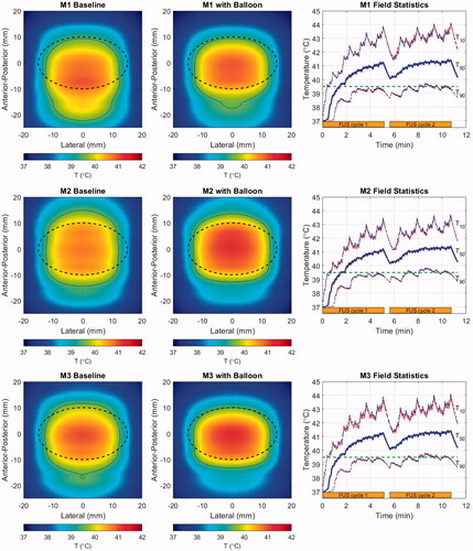 Figure 9. Cycle-2 time-averaged temperature maps projected in the lateral-A-P plane for the baseline (left) and balloon-deformed (center) configurations of each patient model, and histories (right) for T50 (thick line) and T10/T90 (thin lines) spanning two treatment cycles (orange bars). In the temperature maps, overlaid lines indicate the PDAC target (dashed black) and the 39.5 °C iso-contour (thin black). Colors in the field statistics denote the baseline (red), and balloon-deformed tissue (blue). Upper row: M1 (70 mm target depth), Middle row: M2 (66 mm target depth), Lower row: M3 (55 mm target depth).