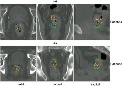 Figure 4.  FDG (green) and FMISO (a) (red) or FLT (b) (red) tumour contours before and FDG (blue) and FMISO (a) (yellow) or FLT (b) (yellow) tumour contours during chemoradiation (CRT) after overlaying the PET/CT scans to the baseline FDG-PET/CT (displayed) in axial, coronal and sagittal plane.