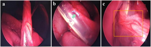 Figure 2. Performance of the omental wrapped model in beagles.a. Complete encapsulation of the peritoneal dialysis catheter by the omentum. b. Green arrow: Omental wrapped the side holes of catheter and entered the lumen. c. Orange box: Omental wrapped the tip of the catheter.