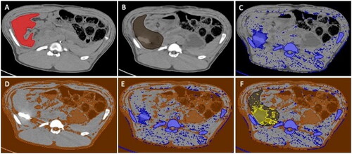 Figure 1. Semiautomatic segmentation steps. The volume of liver tissue without artifacts shown in red (A); The volume of interest encompassing ablation probe and artifacts within the liver in black (B); Voxels below the lower threshold in blue (C); Voxels above the upper threshold in brown (D); Union of voxels beyond the thresholds (E); Intersection of the volume of interest of the liver with the union of voxels beyond the thresholds resulting in artifact volume shown in yellow (F). Thresholds were calculated for each animal separately.