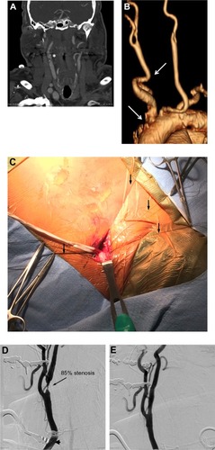 Figure 1 Case illustration of the Reverse Flow Used During Carotid Artery Stenting Procedure (ROADSTER).