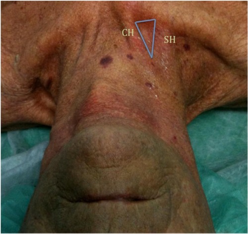 Figure 3 Photograph of neck in a malnourished patient demonstrating surface anatomy.