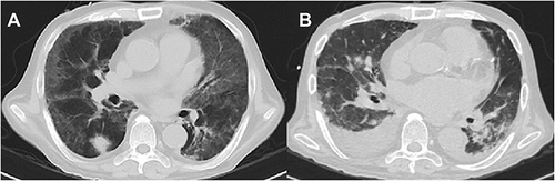 Figure 2 (A) (2019–06-27) Patchy, flocculent and ground glass-like shadows were seen in both lungs, a nodule was seen in right lung. (B) (2019–07-22) Patchy, nodular and banding shadows had significantly increased, and bilateral pleural effusion.