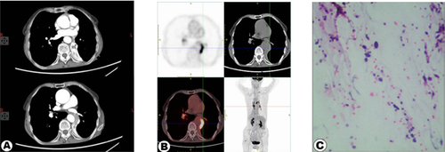 Figure 1 Pathological and image findings of the patient on the first visit. (A) A chest CT scan on December 17, 2021 (A) revealed a soft tissue mass with a disrupted bronchus in the left lower hilar area. The mass had well-defined borders and measured approximately 2.9×1.3 cm with a CT value of approximately 46 Hounsfield units (HU). The arterial phase enhancement showed CT values of 105 HU and 122 HU, respectively. Atelectasis was observed in the left lower lobe. Multiple nodular opacities were found in both lungs, with miliary opacities and a larger opacity measuring approximately 0.7 cm in diameter in the right upper lung, showing spiculation and adjacent pleural traction. (B) A PET/CT scan on December 23, 2021 (B) showed increased FDG metabolism in a mass in the left lower hilar area with a maximum standardized uptake value (SUVmax) of 11.2, measuring 3.1×1 cm. This was suggestive of central-type lung cancer in the left lung with associated atelectasis in the left lower lobe. A small nodule measuring 0.8 cm in the right upper lobe showed increased FDG metabolism (SUVmax of 7.5). (C) depicts the pathological slide of the patient’s tumor tissue stained with hematoxylin and eosin. (×400).