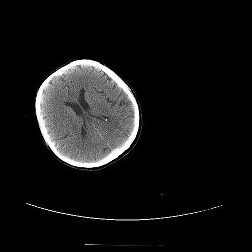 Figure 3. Axial CT scan in the patient after neurological event was normal.