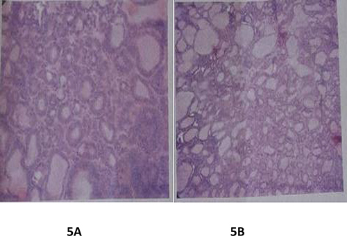 Figure 5 Slides showing histology of resected thyroid and chest wall mass. (A). Section showing variable increased small follicles along with sheets of malignant follicular cells having features of capsular and vascular invasion (B). Tissue sent from resected chest wall mass showing similar malignant cells with formation of colloid filled follicles.