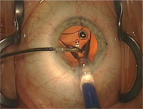 Figure 3 Implantation of an acrylic single-piece intraocular lens using balanced salt solution irrigation only.
