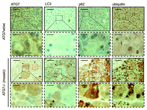 Figure 2. Detection of a punctate LC3-staining pattern in murine wild-type pancreas and uniform staining in atg7−/− tissue. Immunohistochemical staining for ATG7, LC3, SQSTM1/p62 and ubiquitin in murine wild-type pancreata (top two rows) and in consecutive sections from pancreata with mosaic deletion of ATG7 (atg7−/−, bottom two rows). Panels with straight borders are complete, i. e. not cropped and representative overview images taken at 40x magnification with a scale bar (straight) that represents 100 µm. Panels with dashed borders are zoomed and cropped sections from the overview panels (cropped regions are indicated by the small dashed rectangle in the overview panels). The dashed scale bars in the cropped panels represent 20 µm. IHC was done on consecutive sections for the atg7−/− samples and each display two large, not recombined (i.e., Atg7wt/wt) regions of pancreatic acinar tissue that are marked as (*, **) and encircled in red. In addition two pancreatic islets (#, ##) are also marked and encircled which act as landmark structures to enable clear alignment of sequential sections. Antigen retrieval for LC3 was undertaken in Tris-EDTA, pH 9 for LC3 and in 10 mM Na Citrate buffer, pH 6 for ATG7, SQSTM1/p62 and ubiquitin.