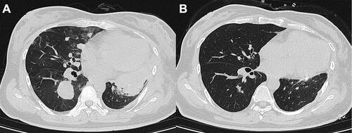 Figure 5 Chest computed tomography (CT) before and after chemotherapy. (A) Chest CT showing multiple nodules and masses in both lungs, the larger of which was about 5.7 cm * 3.4 cm. (B) Chest CT after chemotherapy showing tumors smaller than those before.