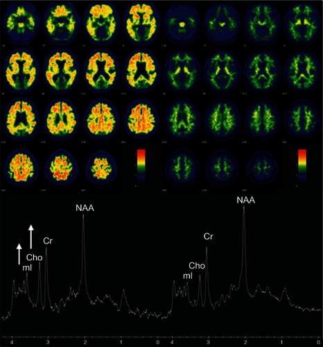 Figure 1 Association between MRS metabolite ratios and cortical Pittsburgh compound-B (PiB) retention ratio on PET.