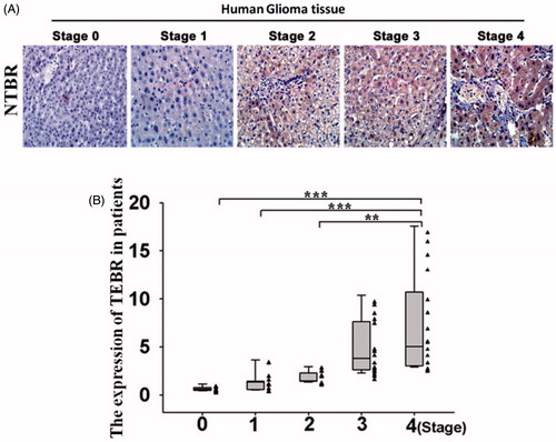 Figure 4. NTBR regulating tumour staging of glioma cells. (A) Immunohistochemistry was used to detect the expression of NTBR in different stages of malignant gliomas; and (B) clinical statistical analysis of NTBR expression in different stages of malignant gliomas.