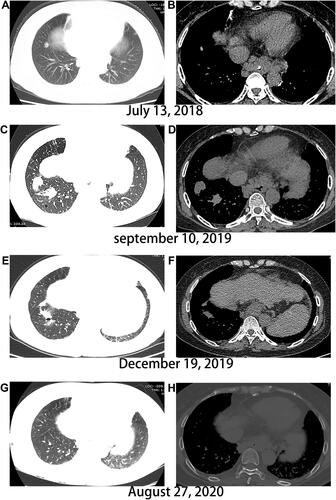 Figure 2 Evolution of HCC lung metastasis. (A and B) No signs of metastasis at admission, (C and D) Multiple lung lesions after therapy with sorafenib for 1 year, (E and F) Volume of lung lesions decrease after treatment with regorafenib combined with sintilimab for 3 months. (G and H) Complete remission of lung metastasis.