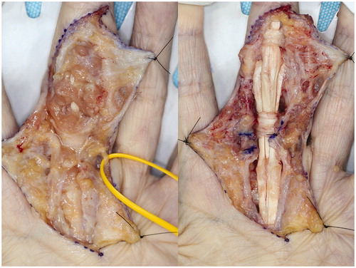 Figure 5. Intraoperative photograph of the third synovectomy. Left: Before synovectomy. Right: After synovectomy.